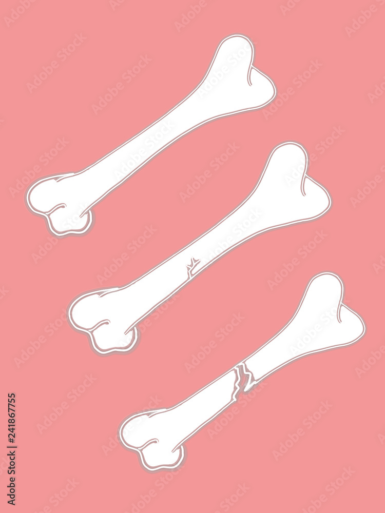 broken bone fractured bone and bone cartoon illustration Stock Illustration  | Adobe Stock