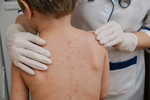 Doctor examines baby's skin full of blisters,scar and rash caused by chickenpox