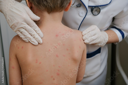 Fotografie Doctor examines baby's skin full of blisters,scar and rash caused by chicken pox