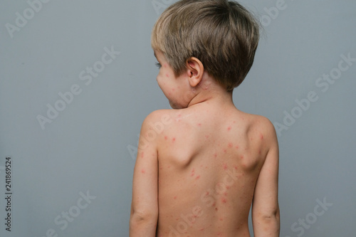 Closeup of back and neck full of blisters,scar and rash caused by chickenpox