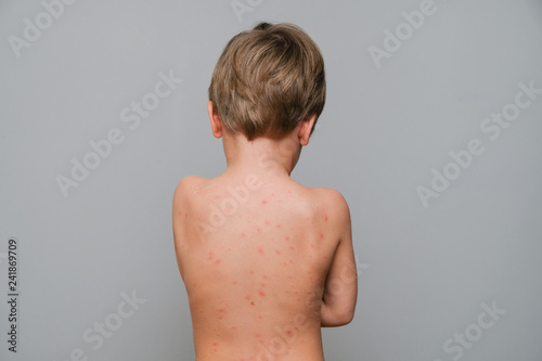 Photos Closeup of back and neck full of blisters,scar and rash caused by chickenpox, va
