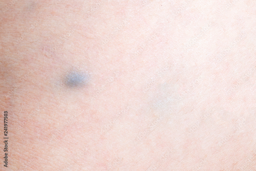 varicose vein disease in a woman, closeup image
