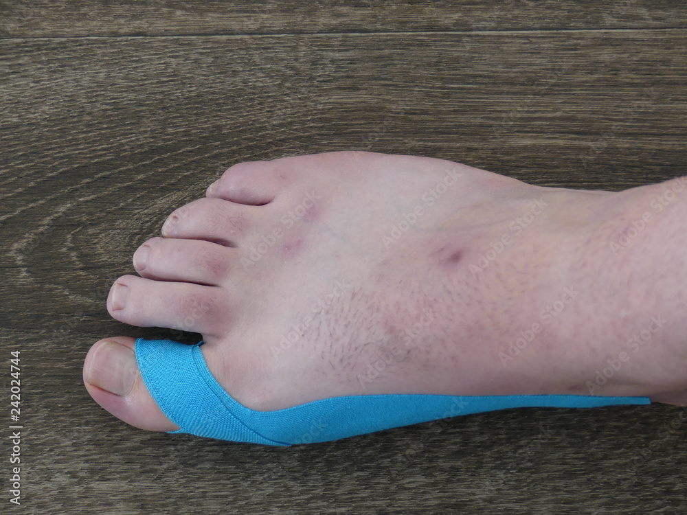 Naklejka premium Medical Taping Hallux Valgus