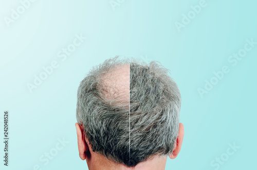 Before and after, Rear view of a male head without hair. Hair loss concept, bird's nest on the head. Problems with hair regrowth, shampoo for facial hair growth.