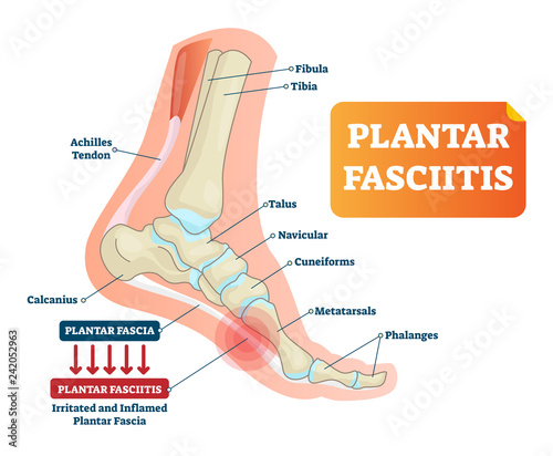 Plantar fasciitis vector illustration. Labeled human feet disorder diagram.