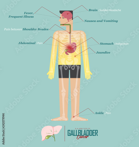 Alarm signs of Gallbladder cancer infographic in flat design. Gallbladder cancer disease symptom icon set  with human body, skeleton and organ. Vector Illustration.