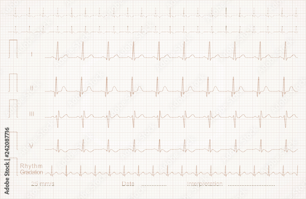 cardiogram on the linear graph paper