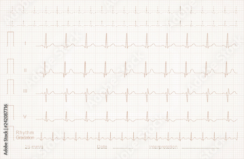 cardiogram on the linear graph paper