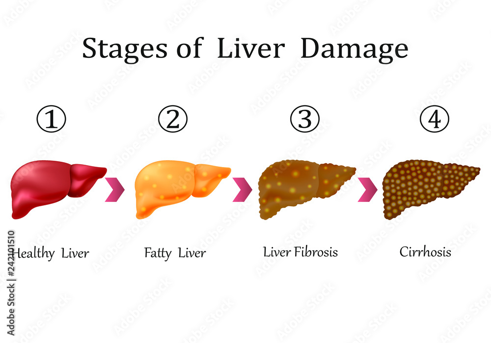 Stages of liver damage, liver disease. Healthy, fatty, liver fibrosis and cirrhosis isolated on