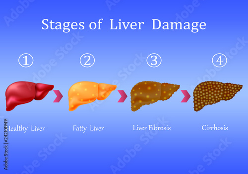 Stages of liver damage, liver disease. Healthy, fatty, liver fibrosis and cirrhosis isolated on blue background.Vector illustration
