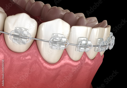 Teeth Clear braces in gums. Medically accurate dental 3D illustration