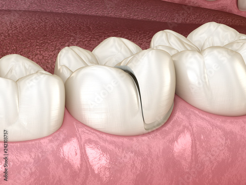 Fototapeta Naklejka Na Ścianę i Meble -  Onlay ceramic crown fixation over tooth. Medically accurate 3D illustration of human teeth treatment