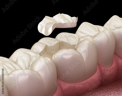 Fotografie Inlay ceramic crown fixation over tooth