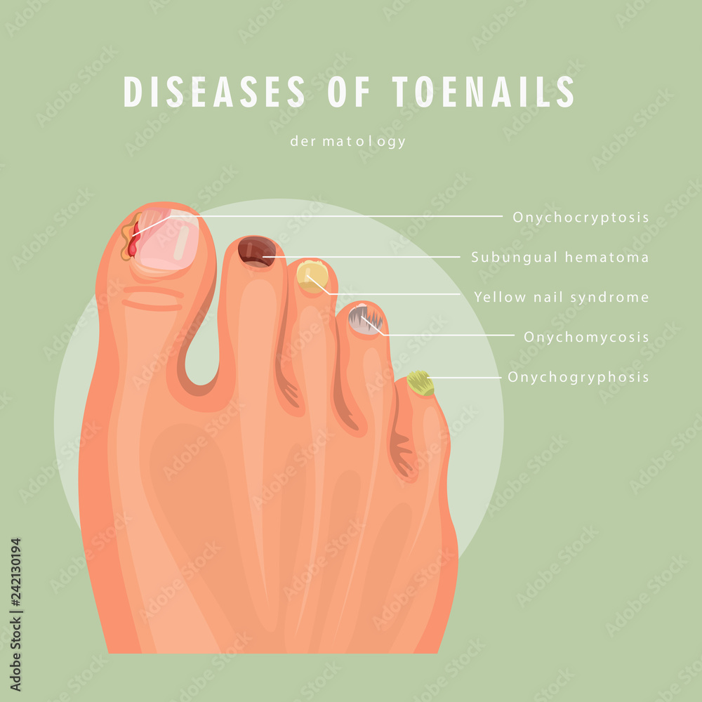 Fungus toenail infection vector medicine poster. Colorful design ...