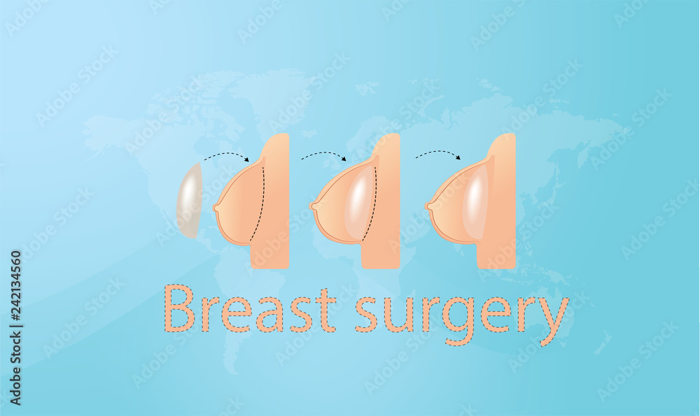 Breast surgery concept