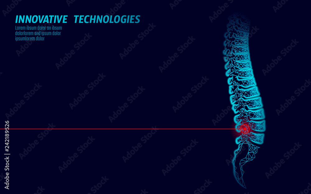 Laser physiotherapy human spine injury. Pain area surgery operation modern loin medicine technology low poly triangles 3D render female back hernia vector illustration - obrazy, fototapety, plakaty 