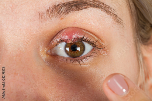 Hordeolum on upper eyelid. Viral infection photo