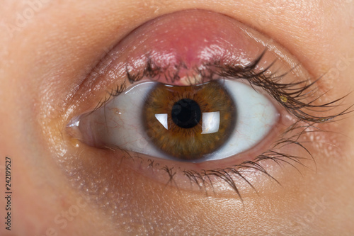 Fototapeta Naklejka Na Ścianę i Meble -  Hordeolum on upper eyelid. Viral infection
