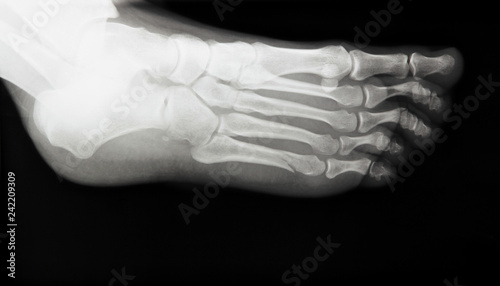 Medical X-Ray of a Broken Foot