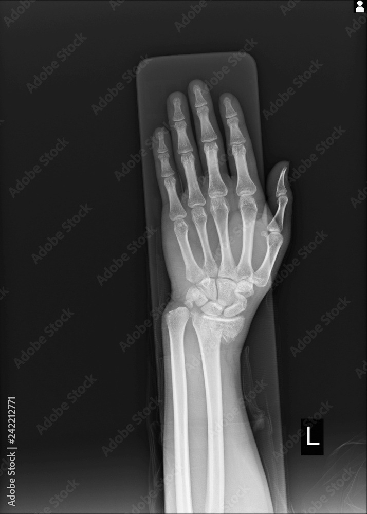 Xray Left wrist joint Fracture with displacement distal end left