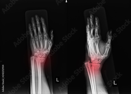 X-ray Left wrist joint Fracture with displacement distal end left radius. photo