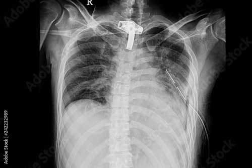 Pulmonary contusion and hemothorax with ICD