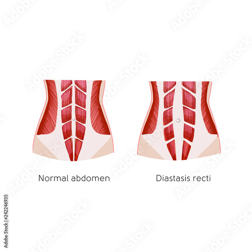 Diastasis recti. Abdominal muscle diastasis after pregnancy. Abdominal problems. Anatomy vector illustration photo
