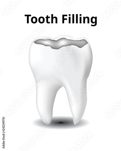Tooth Filling, isolated on white background, Realistic design illustration Vector.
