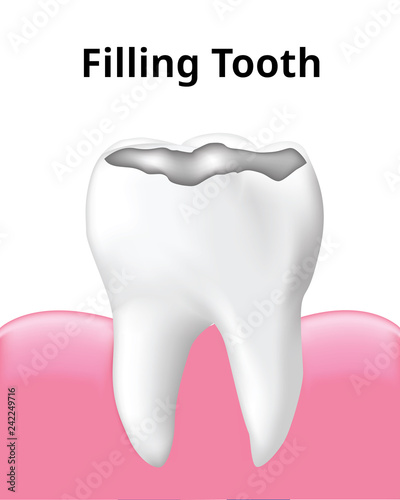 Tooth Filling with gum, isolated on white background, Realistic design illustration Vector.