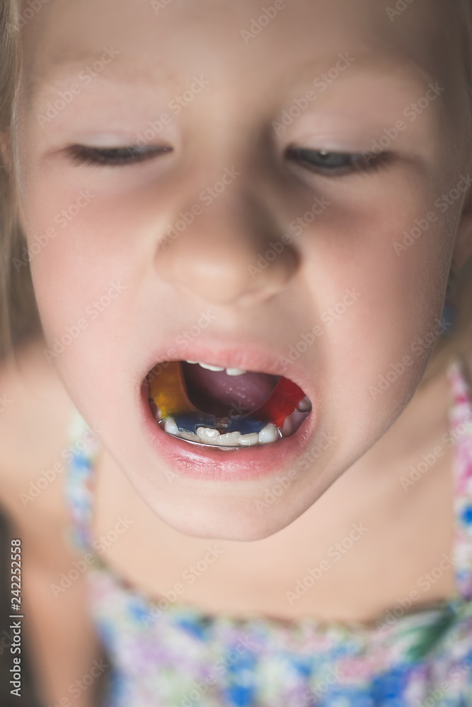A little girl with crooked teeth shows an orthodontic appliance in her mouth. A little girl with crooked teeth shows an orthodontic appliance in her mouth.