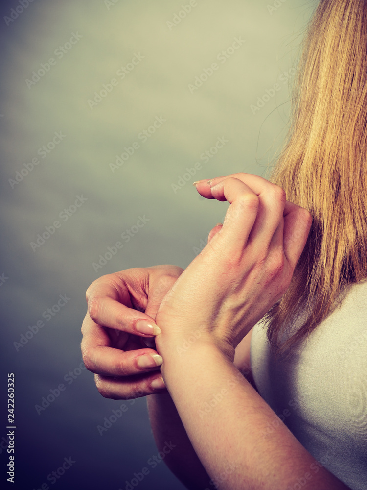 female scratching her itchy wrist with allergy rash - obrazy, fototapety, plakaty 