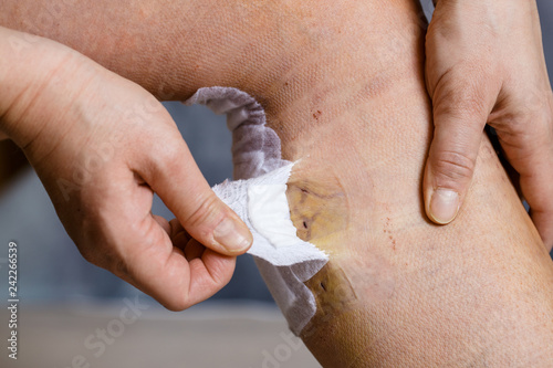 Obraz na płótnie Removing bandages after varicose vein surgery w salonie