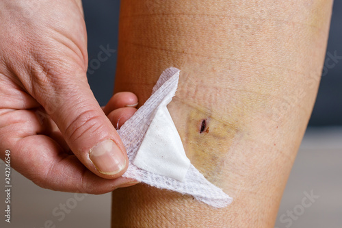 Removing bandages after varicose vein surgery photo