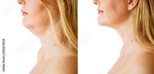 Woman before and after chin fat correction procedure photo