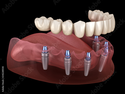 Mandibular prosthesis All on 6 system supported by implants. Medically accurate 3D illustration of human teeth and dentures concept