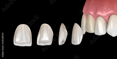 Fototapeta Naklejka Na Ścianę i Meble -  Veneer installation procedure over central incisor and lateral incisor. Medically accurate tooth 3D illustration