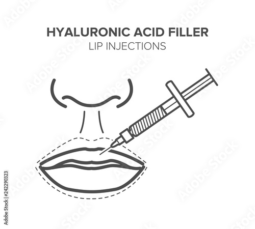 Hyaluronic acid filler. Lip injections. Vector illustration