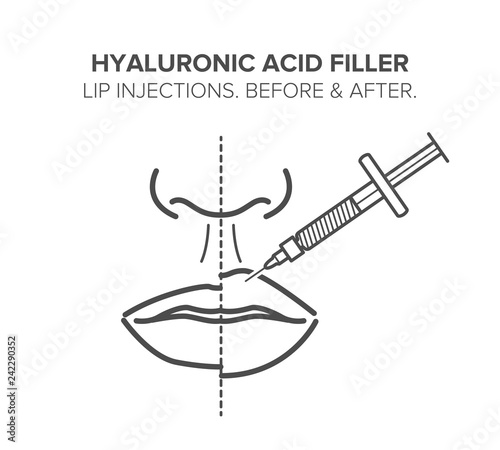 Lip injections. Hyaluronic acid filler. Before and after. Vector illustration