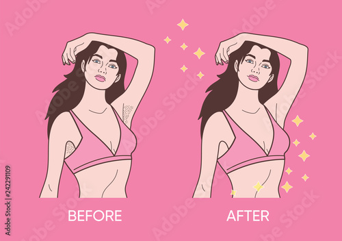  underarm hair removal