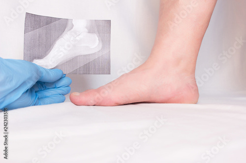 doctor holds x-ray in his hand and examines patient's leg with heel spur, close-up, plantar fasciitis photo