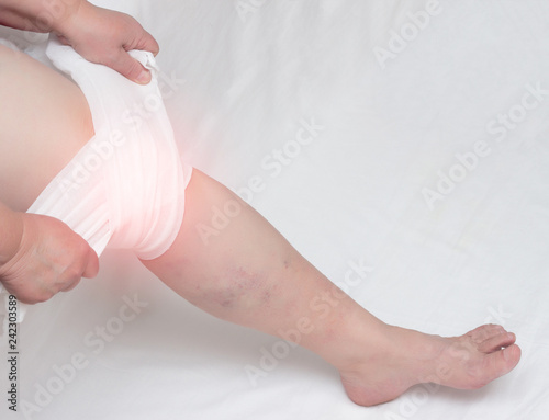 Treatment of arthritis of the knee and inflammation with a medical compress, tight bandage, close-up, copy space, synovitis photo