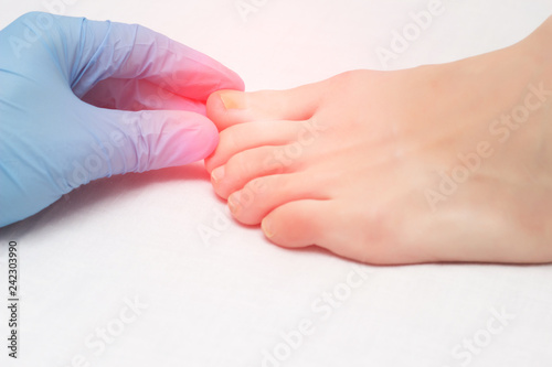 Canvas Print Doctor examines a sore toe infected with fungal infection, close-up, onychomycos