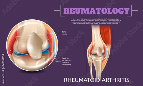Realistic Illustration Knee Rheumatoid Arthritis