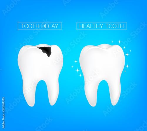 Caries and healthy tooth comparision. Dental care concept   Oral Care  teeth restoration. illustration isolated on blue background.