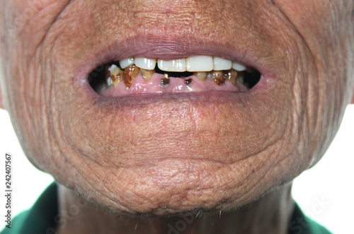 Photography Elderly Asian man showing severe teeth decay causing foul smell, black and numerous limestones at gums due to betel nuts chewing for a long time