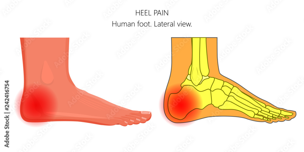 Vector illustration of unhealthy human foot with pain in the heel bone. Anatomy of the ankle