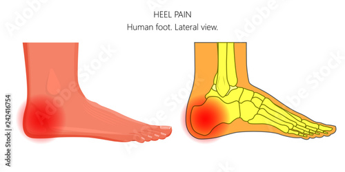 Vector illustration of unhealthy human foot with pain in the heel bone. Anatomy of the ankle. Lateral or side view of the foot. For advertising and other medical publications