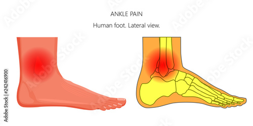 Vector illustration of unhealthy human foot with ankle joint pain or injury. Lateral or side view.  For advertising and other medical publications