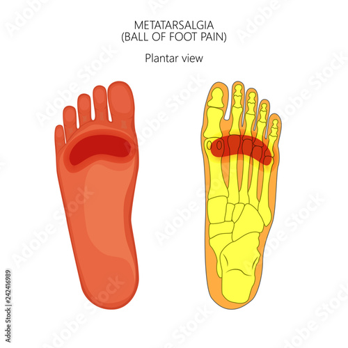 Vector illustration of forefoot pain, metatarsalgia symptom, tenderness in the balls of metatarsal bones of the foot. For advertising and other medical publications photo