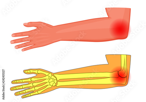 Vector illustration of a human elbow joint with a pain or injury.
